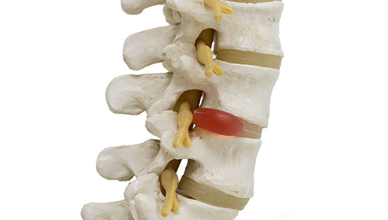 Herniated disc in spine before visiting Akron chiropractor