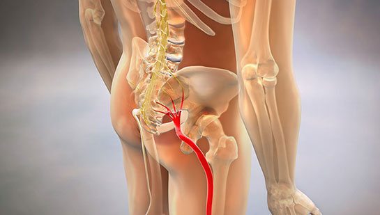 Sciatic nerve pain before chiropractic treatment from Akron chiropractor